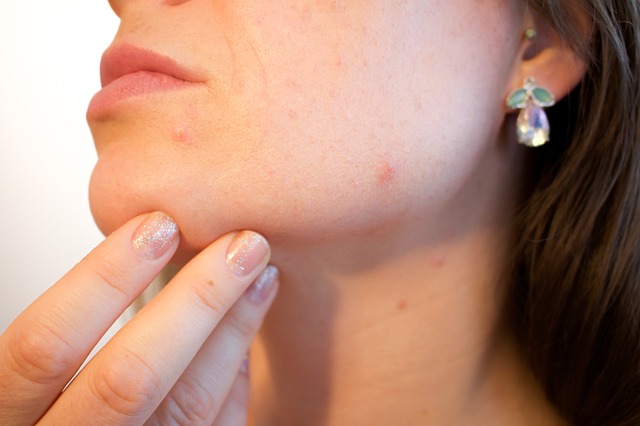 skin care, acne, breakouts